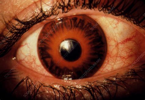 Glaucoma Swollen Inflamed Eye With Contact Lens Stock Image M155