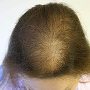 Hair Loss In Women Limmer Hair Transplant Center