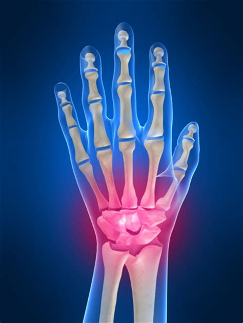 Wrist Injury: Office Workers Prone To Wrist Injury ...