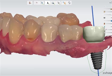 Lower Second Molar Replacement With Dental Implant Lower Second Molar