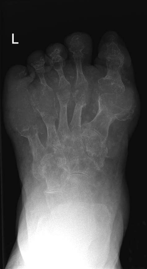 Gout - Radiology at St. Vincent's University Hospital