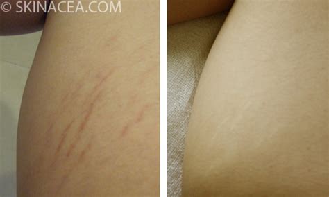 How To Get Rid Of Stretch Marks