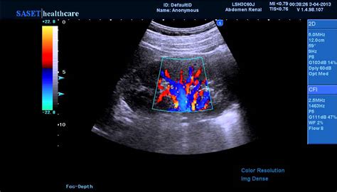 Renal Doppler Scan By Colored Ultrasound Imagoc21 Youtube