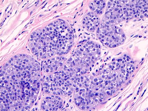 Pathology Outlines Lobular Carcinoma In Situ Lcis Classic
