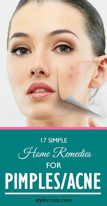 17 Simple Home Remedies For Pimplesacne Home Remedies For Pimples