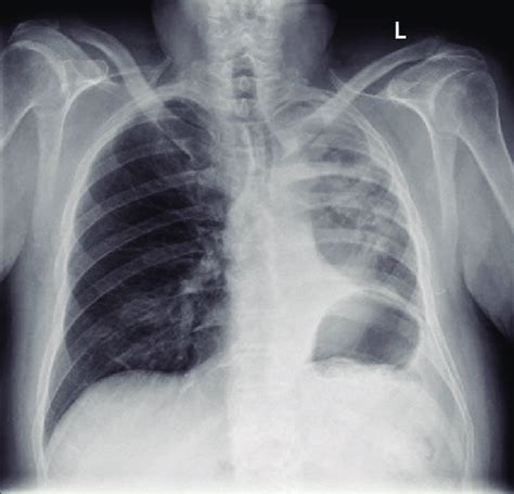 Chest X Ray Showing A Small Right Basal Pleural React Vrogue Co