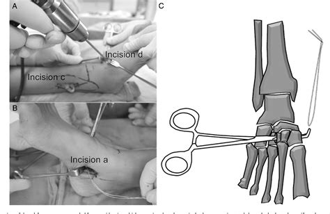 An Innovative Anchoring Technique For Anterior Transfer Of The Tibialis Posterior Tendon