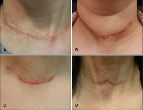 Classification Of Postthyroidectomy Scars A Linear Flat Scar B