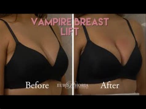 VAMPIRE BREAST LIFT Vampire Breast Lift Experience At EuroPhoria