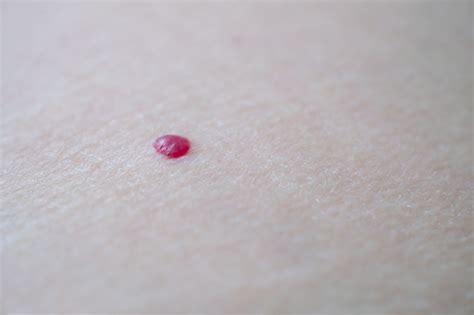 Red Moles On Skin Closeup Stock Photo Download Image Now Adhesive