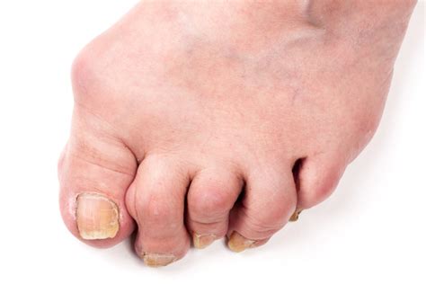 Rheumatoid Arthritis Knowle And Dorridge Foot Clinic