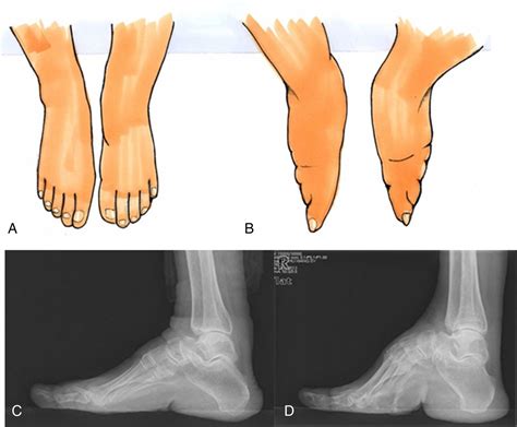 Lifelong Bound Feet In China A Quantitative Ultrasound And Lifestyle