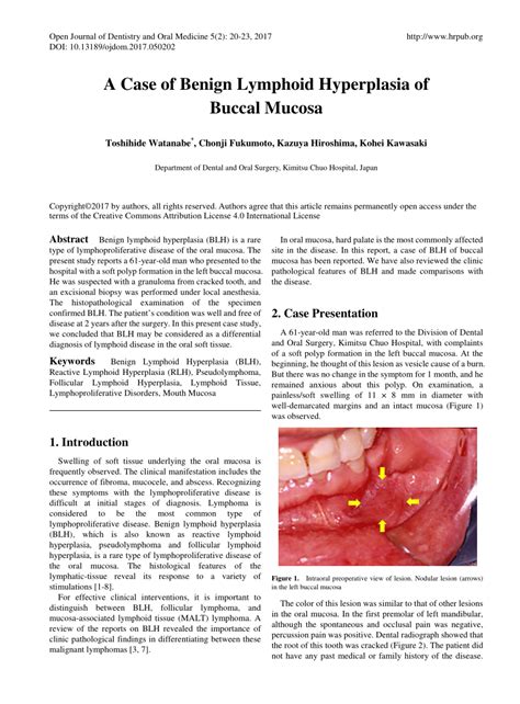 Pdf A Case Of Benign Lymphoid Hyperplasia Of Buccal Mucosa