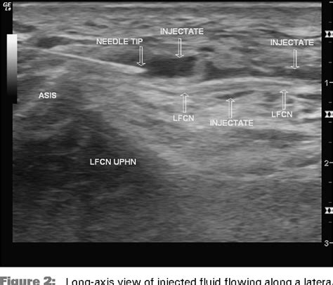Figure 3 From Ultrasound Guided Percutaneous Neuroplasty Of The Lateral