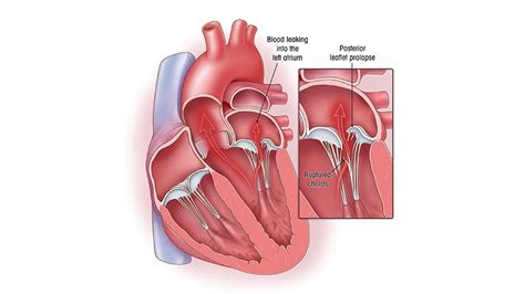 Moderate Mitral Valve Regurgitation Life Expectancy Life Cake Gala