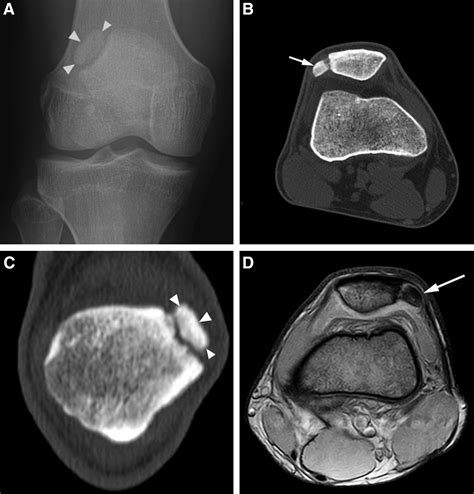 Clinical Outcome Of Arthroscopic Lateral Retinacular Release For