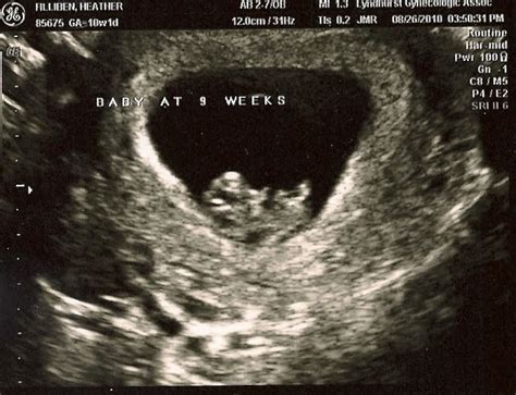 Two Lil Fillibens First Ultrasound 9 Weeks