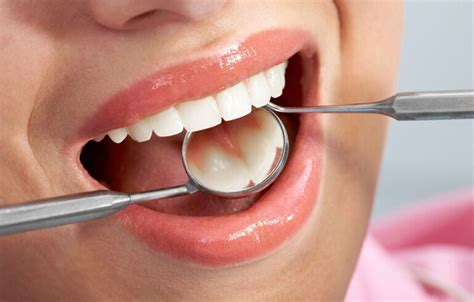 White Fillings Vs Amalgam Fillings Advanced Dental Aesthetics