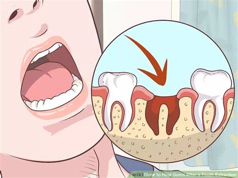 How To Heal Gums After A Tooth Extraction With Pictures Artofit