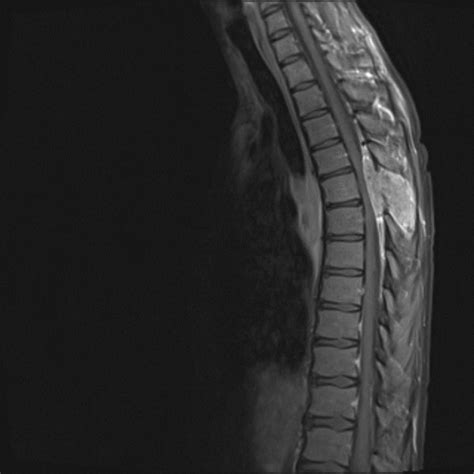 Mri Of The Thoracic Spine In Sagittal View T1 Weighed Image With