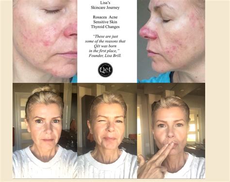 My Skincare Journey With Before And After Images Along The Way Qēt