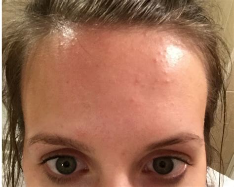 How I Cleared The Tiny Bumps On My Forehead Skincareforacneproneskin
