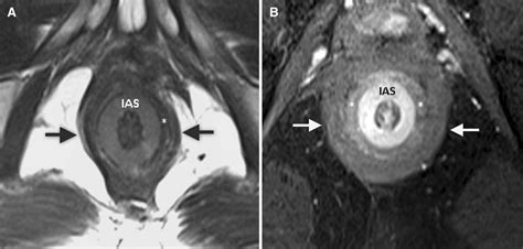 Mri Of Anal Canal Normal Anatomy Imaging Protocol And Perianal Fistulas Part 1 Springerlink