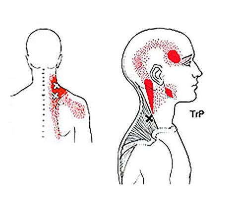 What Is Trigger Point Therapy