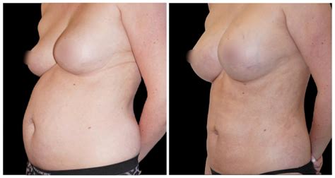 Fat Transfer To Breast Plastic Surgery Yazdani Aesthetics