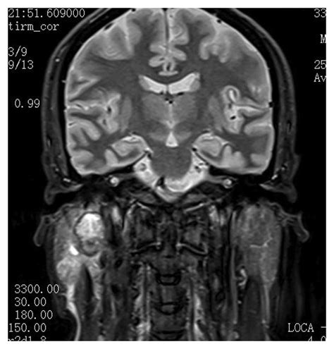 Salivary Duct Carcinoma Of The Parotid Gland A Case Report And Review