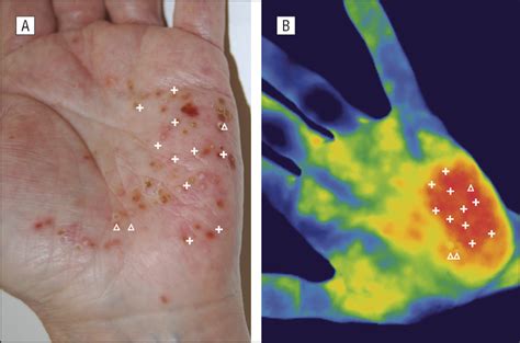 Pustular Psoriasis