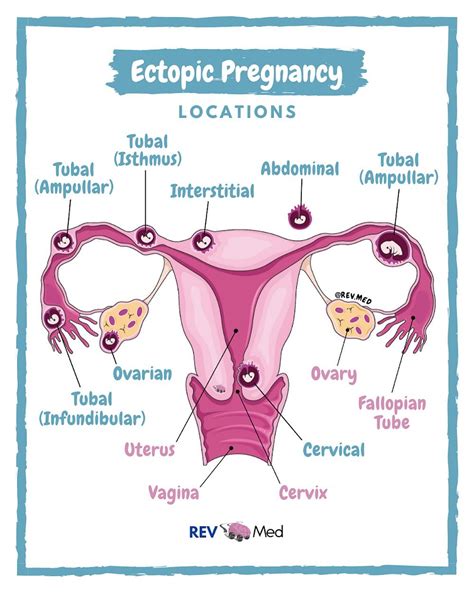 Ectopic Pregnancy Locations Ampullary Interstitial Grepmed