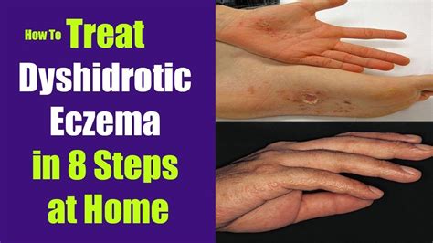 How To Treat Dyshidrotic Eczema In 8 Steps At Home Eczema Eczema