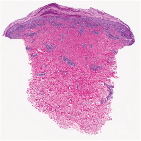 Perivascular Diffuse And Granulomatous Infiltrates Of The Reticular