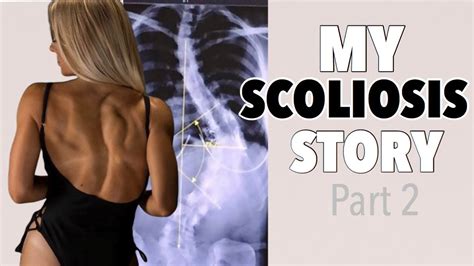 My Scoliosis Story Part 2 Youtube