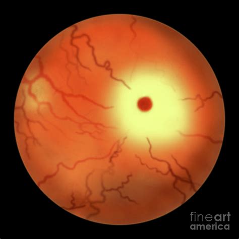 Eye Retina In Tay Sachs Disease Photograph By Kateryna Konscience