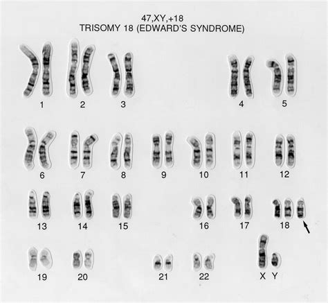 Edward S Syndrome Karyotype Xy Wellcome Collection