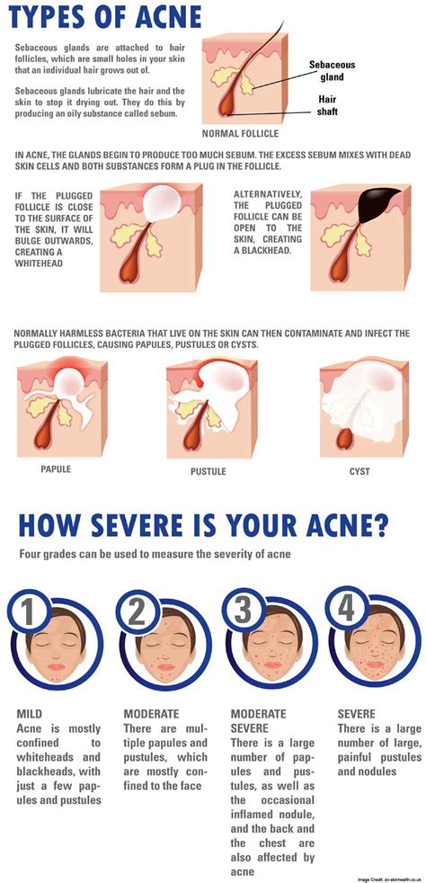 Acne Types Symptoms Causes And Treatments