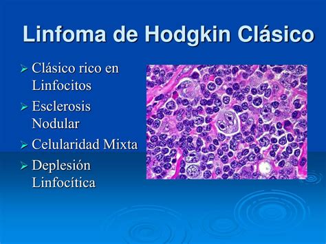 Ppt Linfoma De Hodgkin Clásico Powerpoint Presentation Free Download