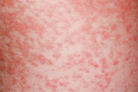 Amoxicillin rash is more common in children with girls being more likely to develop one than boys. Amoxicillin Rash In Glandular Fever Photograph by Dr P ...