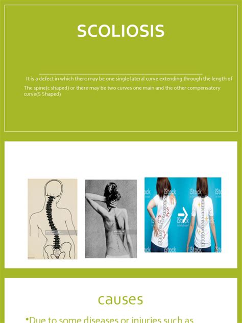 Scoliosis Pdf