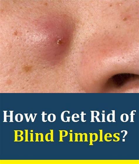 Blind Pimples Treatment