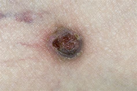 Basal Cell Skin Cancer On The Leg Stock Image C Science Photo Library