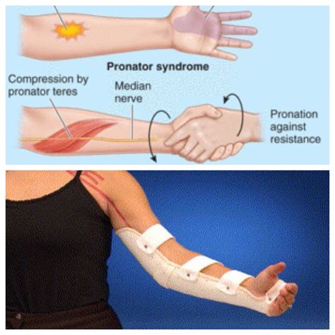 Braceability Cubital Tunnel Syndrome Elbow Brace Splint To Treat Pain