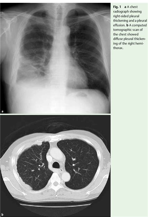Figure 1 From Diagnosis Of Small Bowel Metastasis Of Malignant Pleural