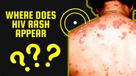Where Does Hiv Rash Appear Skin Conditions Associated With Hiv Youtube