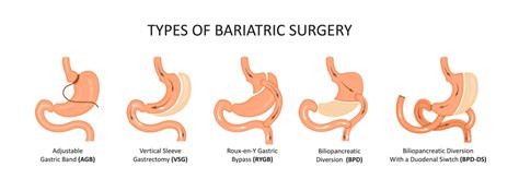 Can Bariatric Surgery Help To Manage Diabetes