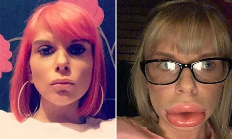 Mother 29 Claims Filler Treatment Left Her With ‘sausage Lips