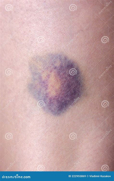 Multi Colored Round Bruise On The Skin Of The Leg Stock Image Image