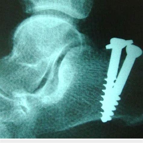 Avulsion Fracture Of The Achilles Tendon From The Calcaneal Tuberosity